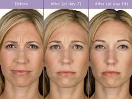 botox 400x300